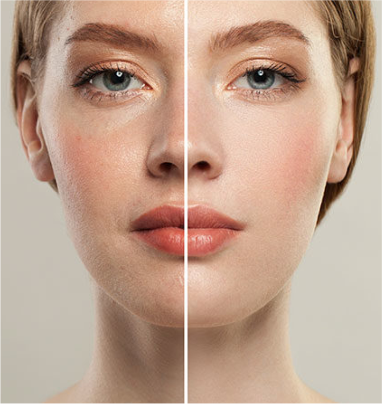 Bioestimulador Facial